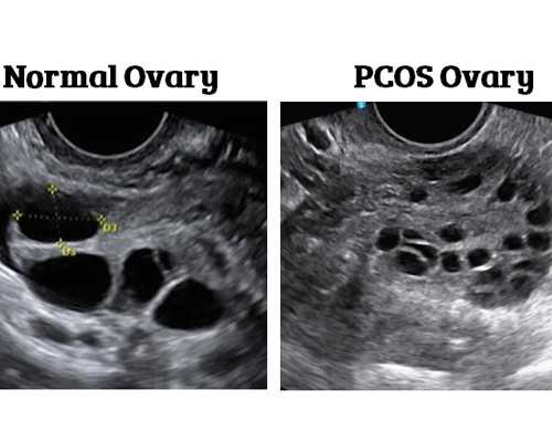 腔镜要坐月子吗？宫腔镜手术后注意什么？~供卵三代包男孩